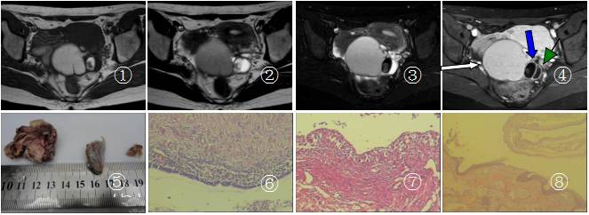 卵巢囊性畸胎瘤10公分严重吗,卵巢囊肿畸胎瘤的囊性和实性区别