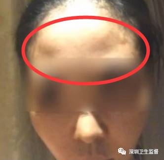 超声刀抗衰老美容仪,抗衰老医美超声刀
