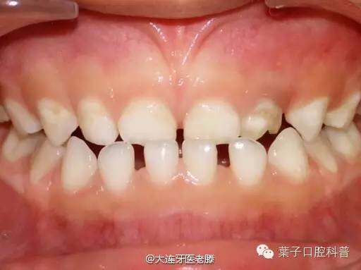 儿童反颌矫正的年龄及步骤,儿童反颌偏颌矫正案例