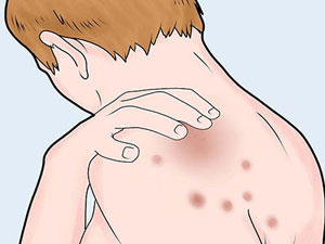 牛皮癣很痒什么东西止痒效果最好,牛皮癣太痒的时候怎样能止痒