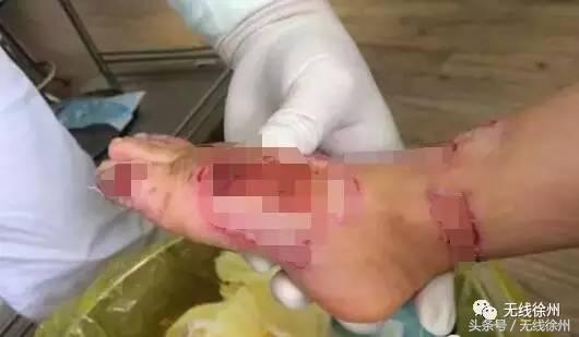 3岁女童被烧成火人!不到半个月徐州一医院已经接了4例!