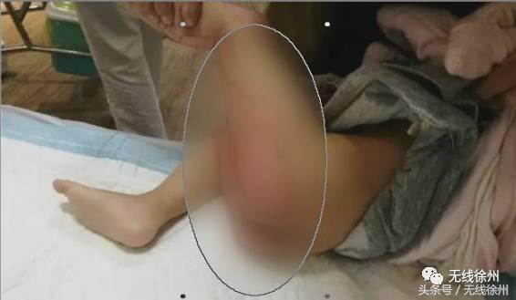 3岁女童被烧成火人!不到半个月徐州一医院已经接了4例!