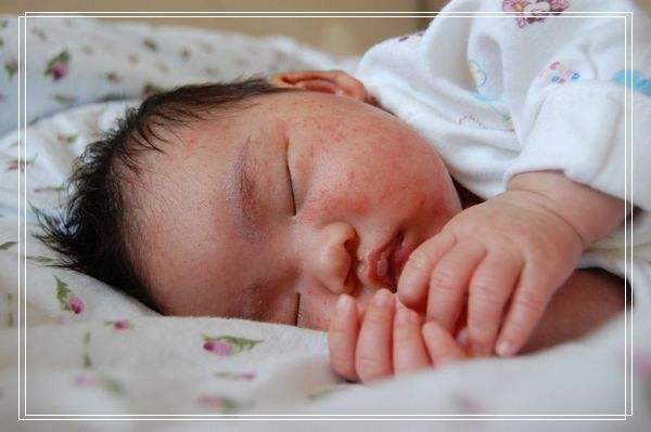 治新生儿湿疹的药,新生儿头上有湿疹