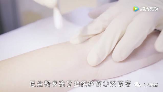 小激光点痣,激光点痣全过程视频