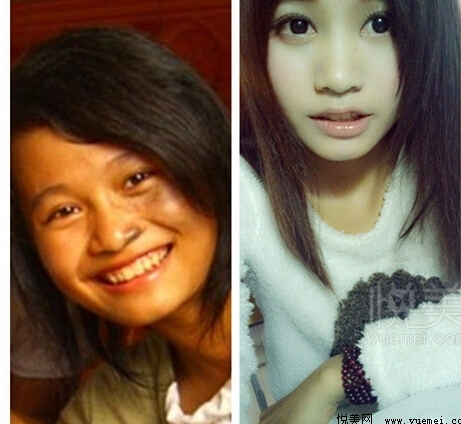 鲜红斑痣加重的三个时期,头上鲜红斑痣得sw综合征的几率