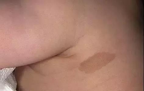 湿疹感染了严重怎么办,湿疹感染的最佳治疗方法婴儿