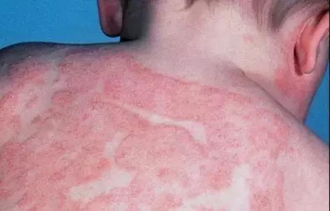 湿疹感染了严重怎么办,湿疹感染的最佳治疗方法婴儿