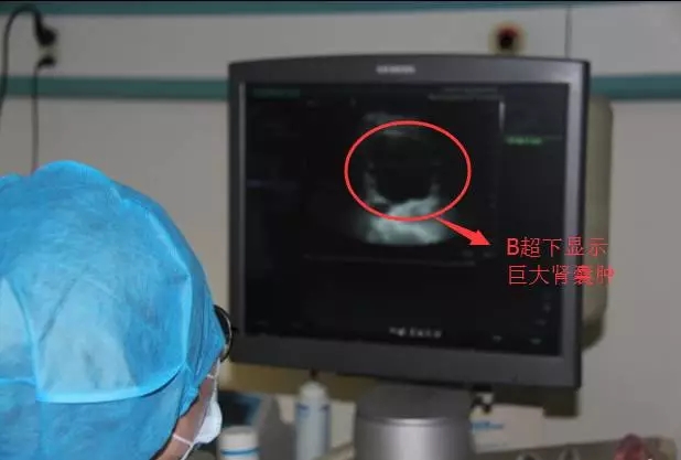 巨大肝囊肿怎么治疗杭州,巨大肝囊肿病例