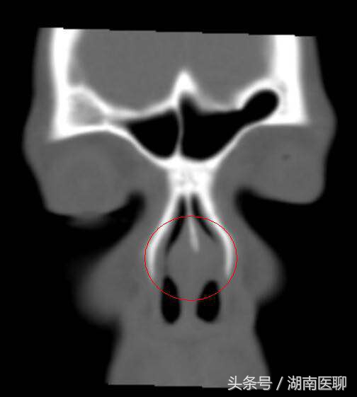 鼻炎清洗鼻子用自来水,鼻炎用自来水冲洗有危害吗