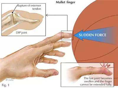 连这种痛都没经历过，都不好意思说你打过球！高手的必修绝技！