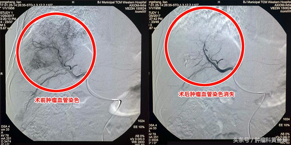 介入栓塞治疗和化疗哪个效果好,肺癌介入栓塞化疗对人的危害