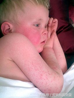如何辨别儿童猩红热,儿童猩红热的症状与表现
