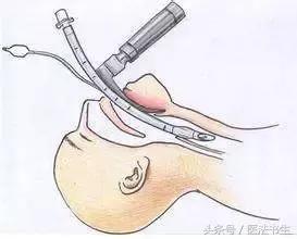 注射死刑前需要打麻醉吗,呼吸麻醉和注射麻醉哪个风险大