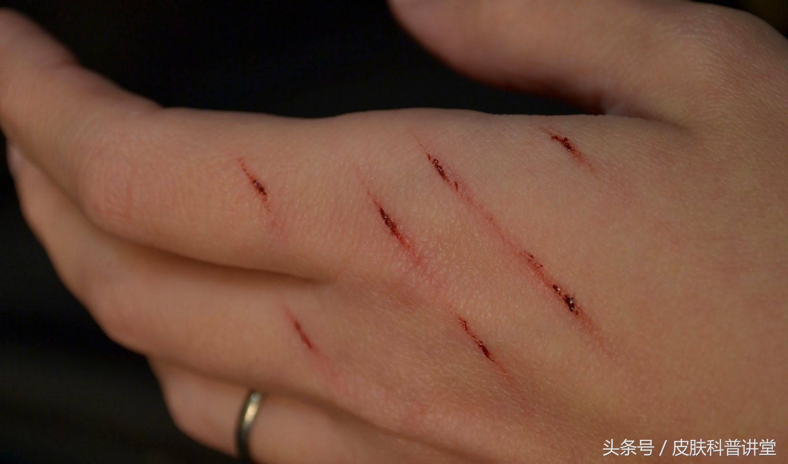 有没有被猫抓过，那你可要留意一下这个皮肤病了，猫抓病