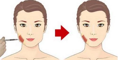 瘦脸针注射次数多了还会有效吗,瘦脸针注射多久后可以恢复自然