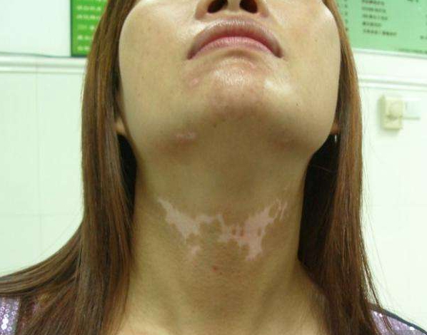 冯导身体健康状况如何了,冯导的白癜风咋样治好的