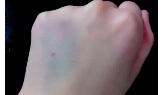 输液手背淤青是热敷还是冷敷,女生输液手背很多针眼和淤青图片