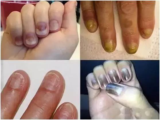 指甲变色变厚怎么处理,指甲变色了怎么办