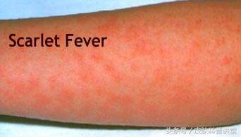 如何辨别儿童猩红热,儿童猩红热的症状与表现