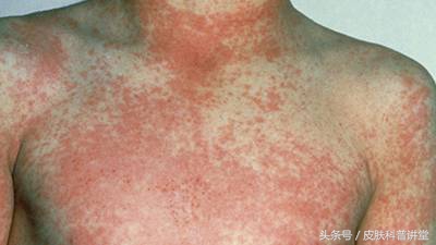 如何辨别儿童猩红热,儿童猩红热的症状与表现