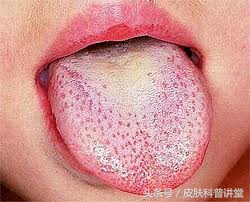 如何辨别儿童猩红热,儿童猩红热的症状与表现