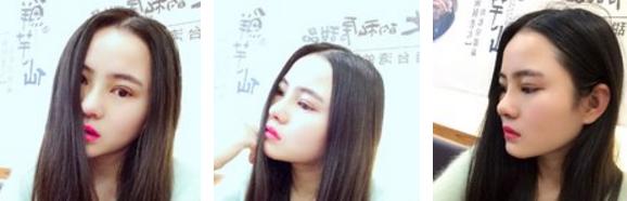 鼻综合7天山根很肿,做完膨体鼻综合修复脸特别肿