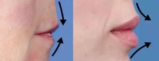 想打玻尿酸有副作用吗,想打玻尿酸怎么打