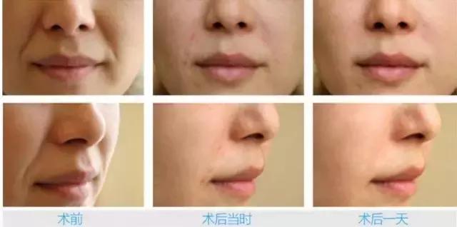 想打玻尿酸有副作用吗,想打玻尿酸怎么打