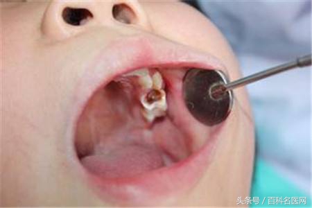 牙髓痛怎么办教你快速止牙痛,牙髓痛和牙根痛的治疗