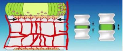 20岁腰椎间盘突出可以完全康复吗,关于腰椎间盘突出你需要知道的