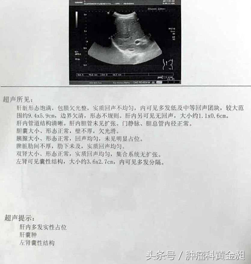 介入栓塞治疗和化疗哪个效果好,肺癌介入栓塞化疗对人的危害