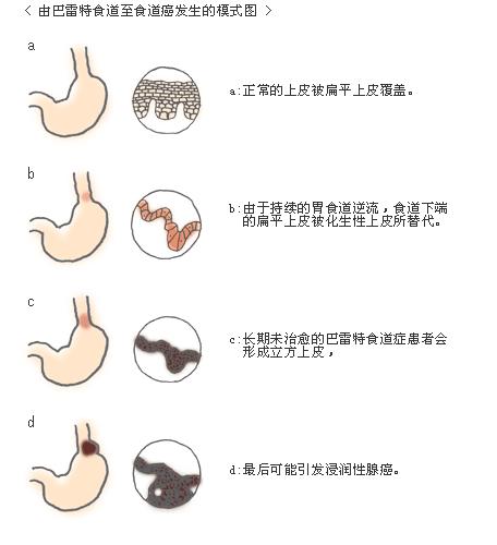 内镜下巴雷特食管,巴雷特食管内镜治疗效果怎样