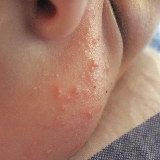 婴儿为什么会长湿疹,婴儿红疹和湿疹区别