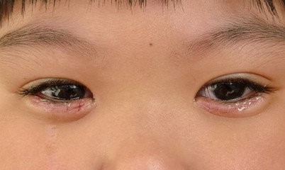 宝宝长倒睫毛，宝妈别再瞎剪了，这样做不对的