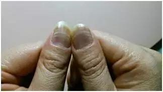 指甲变色变厚怎么处理,指甲变色了怎么办