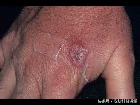 有没有被猫抓过，那你可要留意一下这个皮肤病了，猫抓病