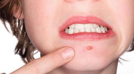 为什么会长痘痘痘痘肌怎么护理,痘痘挤出白色的东西什么原因