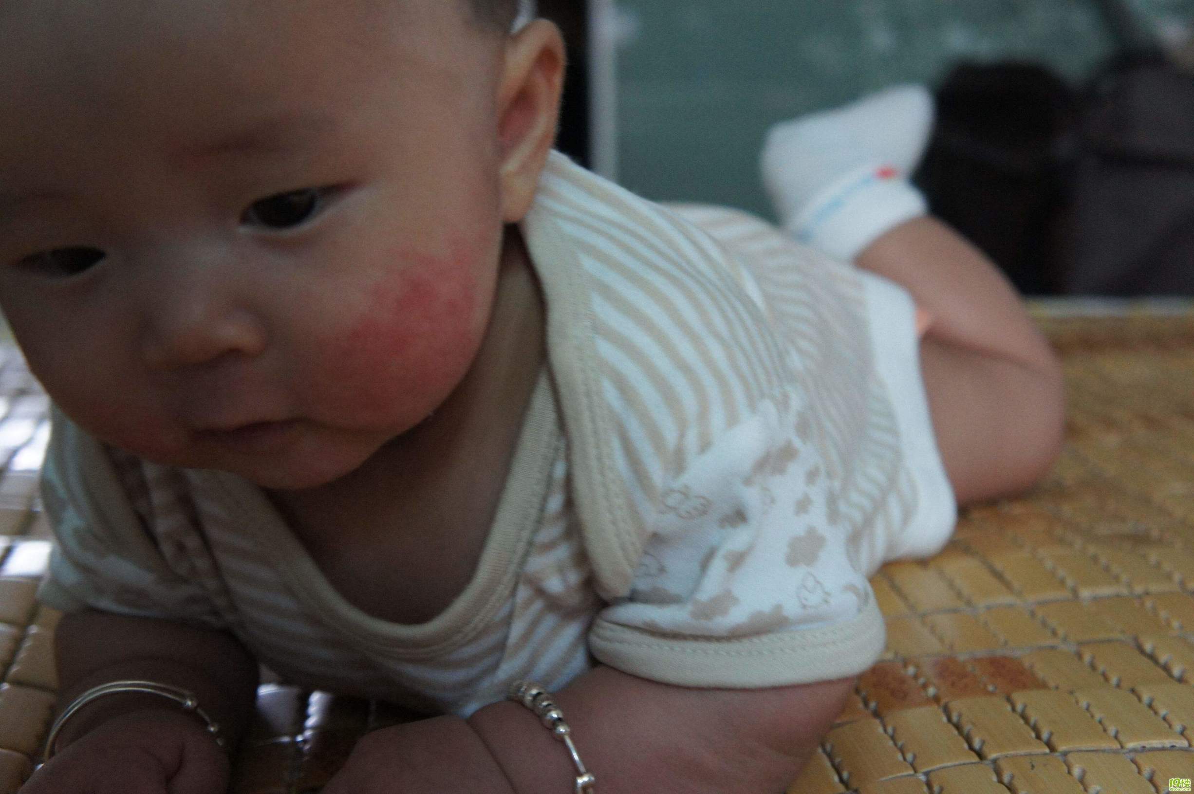 治新生儿湿疹的药,新生儿头上有湿疹