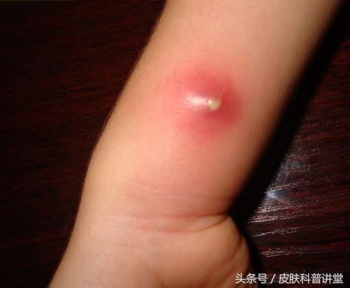 疖病科普文章,疖与疖病