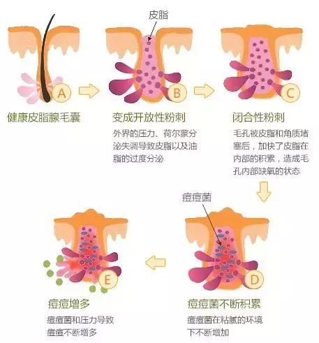 被祛痘的坑了怎么办,被祛痘机构坑了怎么让退剩下的钱