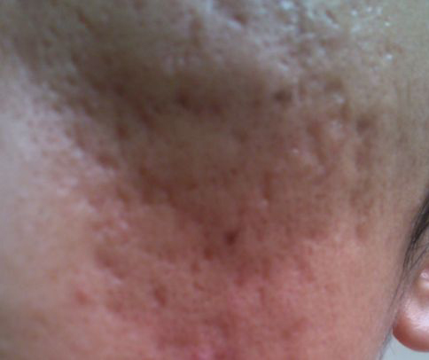 被祛痘的坑了怎么办,被祛痘机构坑了怎么让退剩下的钱