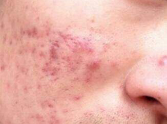 被祛痘的坑了怎么办,被祛痘机构坑了怎么让退剩下的钱