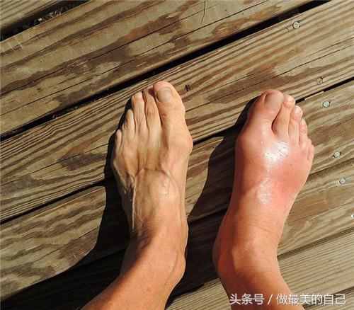 痛风最简单的远离方法,痛风后悔的十大习惯