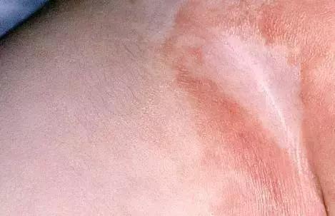 湿疹感染了严重怎么办,湿疹感染的最佳治疗方法婴儿