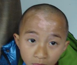 小孩子长了白斑怎么才能治好,声带白斑要注意哪些饮食