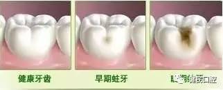 蛀牙根管治疗视频,蛀牙应该怎么治疗最好