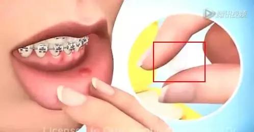矫正钢丝末端扎嘴怎么解决,矫正钢丝末端扎嘴在家怎么办