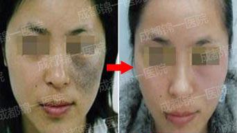 胎记算命揭秘,胎记算命真的可信吗女生