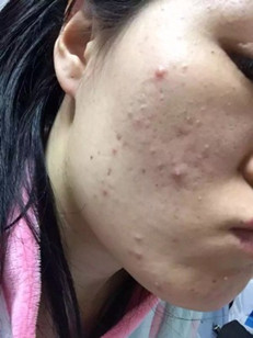 屁股大腿部粗是什么原因,屁股大腿部粗是怎么回事