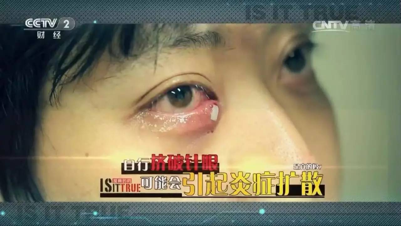 养生骗局早识破,长了针眼没弄破会自愈吗